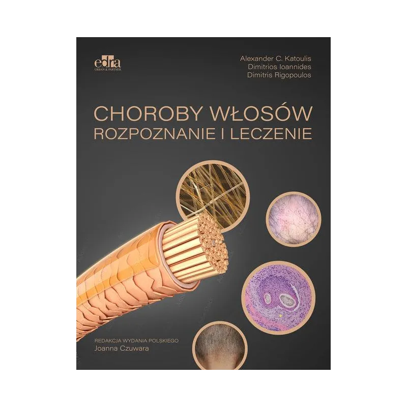 CHOROBY WŁOSÓW. ROZPOZNANIE I LECZENIE