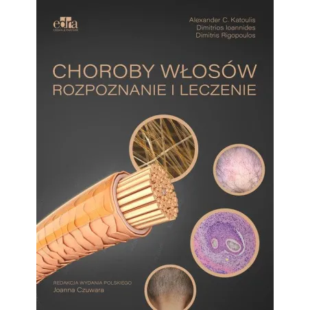 CHOROBY WŁOSÓW. ROZPOZNANIE I LECZENIE