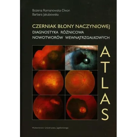 Czerniak Błony Naczyniowej. Diagnostyka Różnicowa Nowotworów Wewnątrzgałkowych. Atlas Czerniak Błony Naczyniowej. Diagnostyka Różnicowa Nowotworów Wewnątrzgałkowych. Atlas